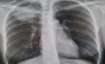Lung cancer