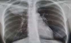 Lung cancer
